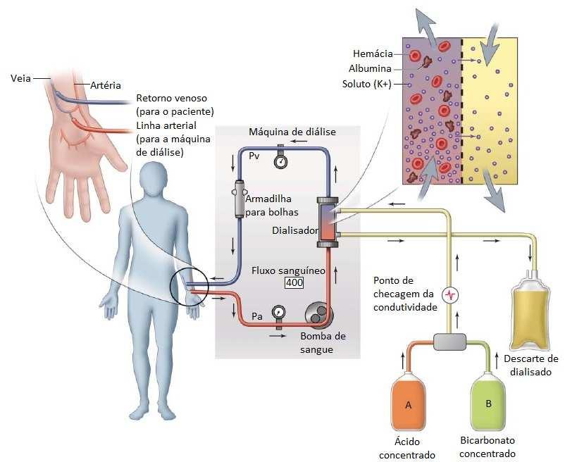 Hemodiálise Fístula Arteriovenosa Hemodiálise Na hemodiálise, há necessidade de diversas