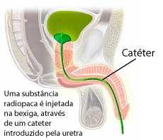 através da sonda vesical um líquido