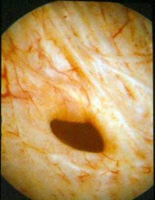 Exame citoscópio (cistoscopia): É a visualização a bexiga, uretra e, em alguns