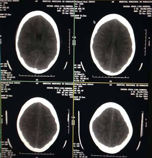 Na unidade de emergência foi solicitada internação hospitalar, TC de crânio e transfusão sanguínea após resultado do hemograma que revelou: