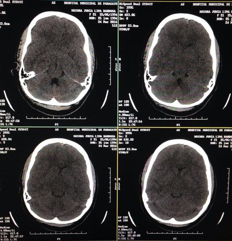 No segundo dia de internação hospitalar paciente apresentando instabilidade hemodinâmica, relatou piora no quadro de cefaleia, sangramento vaginal e