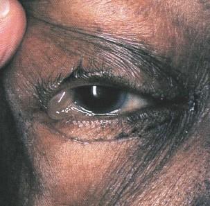 arterial Peso em jejum Perímetros Olhos (quemose) Turgência jugular EXAME FÍSICO Palpação: ascite, edema MMII (sinal do cacifo), região