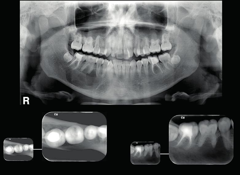 os dentes 45, 46 e 47 imagem compatível com COT. Paciente do gênero feminino, 16 anos de idade.