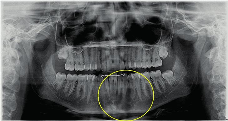 vestibular do processo alveolar da mandíbula. Imagem compatível com COT.