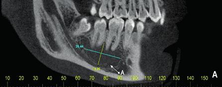 cortes sagital e axial verificamos imagem hipodensa de limites