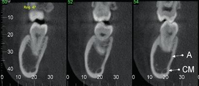 processo alveolar e corpo da mandíbula, lado direito,