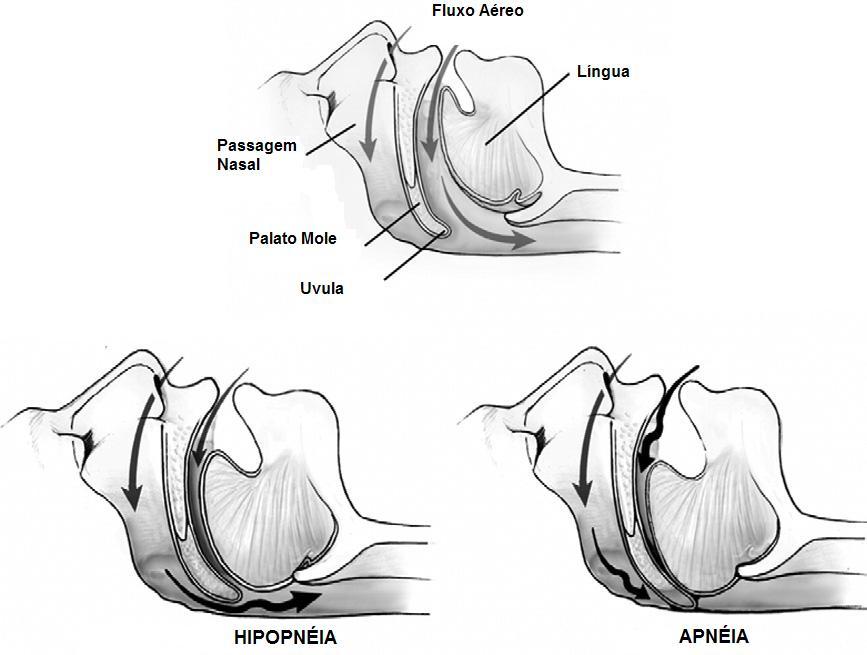 10 Figura 1: Seguimentos mais suscetíveis ao colapso e obstrução parcial (Hipopnéia) e total (Apnéia) na via aérea (Somers VK et al. JACC 2008;52(8):686-717.