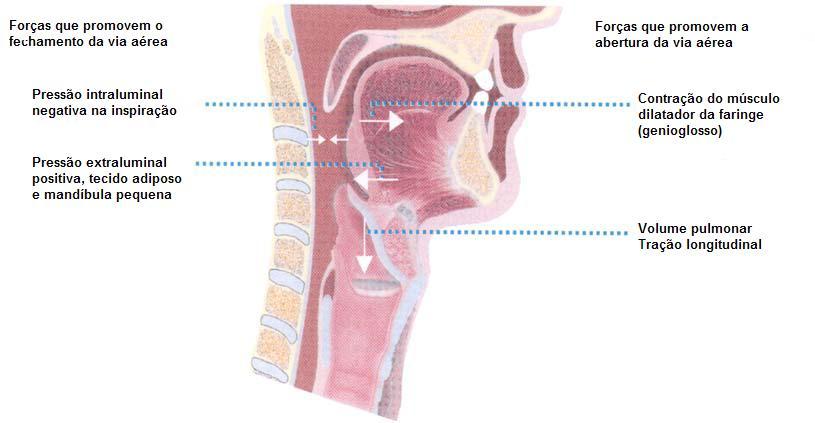11 Figura 2: Corte sagital da via aérea mostrando as variáveis que promovem o colapso e abertura da via aérea (White DP. Am J Respir Crit Care Med 2005;172:1363-1370.