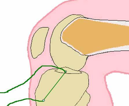 27 Figura 2: Fio Ethibond 5 passado pelo trajeto do fio guia tibial.