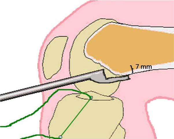 28 b) angulação coronal suficiente para locar a ponta do guia com angulação coronal que corresponda às 11h para