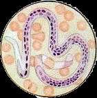Elefantíase A filariose é causada por vermes conhecidos popularmente como filárias.