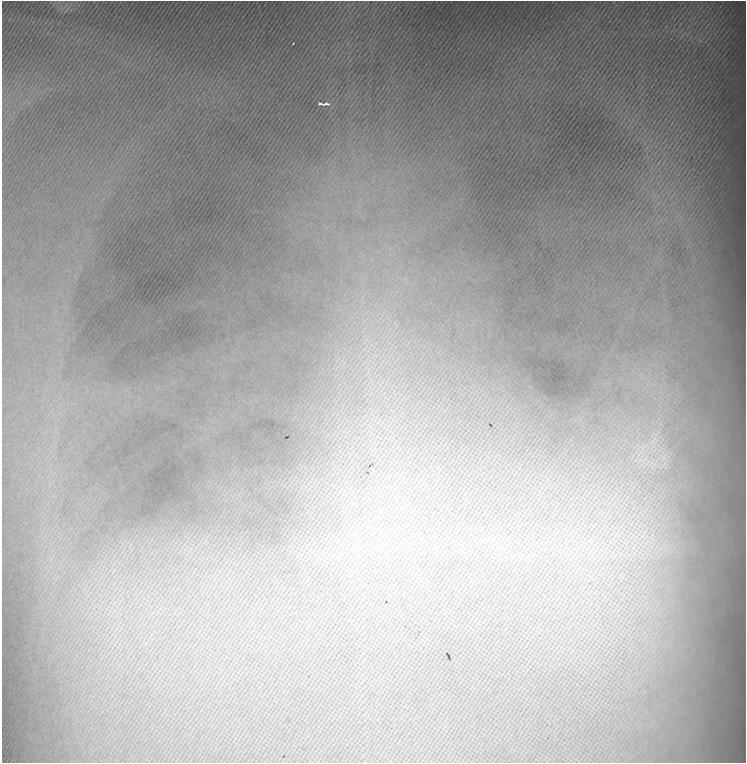 Radiografia PA de tórax Notar o severo edema