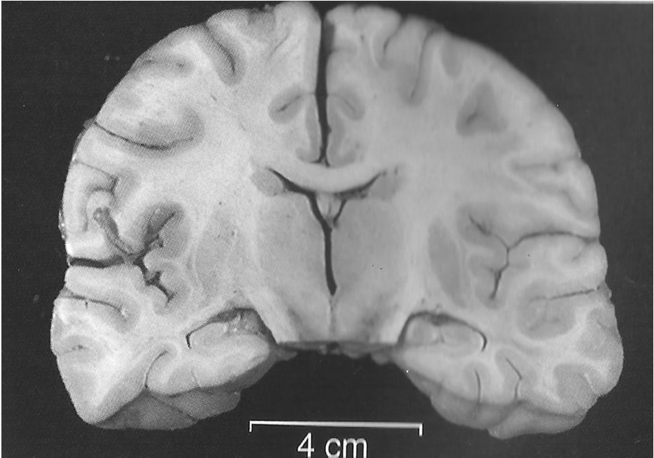 O corte coronal do cerebelo evidencia compressão dos ventrículos