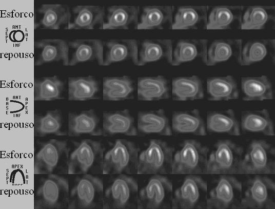 Tabela 1: Parâmetros derivados das imagens do miocárdio.