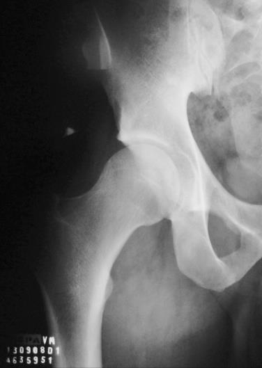 REFERÊNCIAS 21 As características radiográficas que definem o pistol-grip são: a) o achatamento da concavidade da face lateral do colo femoral; b) desenvolvimento de giba na superfície anterolateral