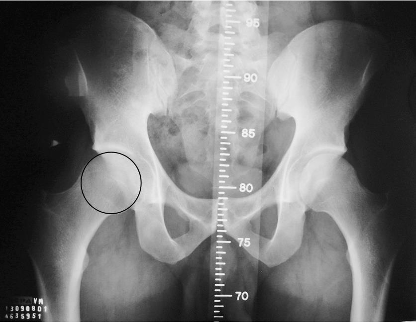 66 THE PREVALENCE OF RADIOGRAPHIC FINDINGS OF FEMOROACETAUBLAR IMPINGEMENT IN ASYMPTOMATIC SUBJECTS AGED BETWEEN 20 TO 40 identify 20 subjects, mainly those