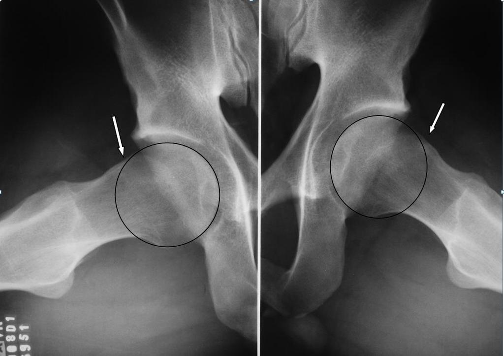 The femoral head showed a triangular index absent bilaterally. Figure 3 - Dünn 45 of patient in Figure 2.