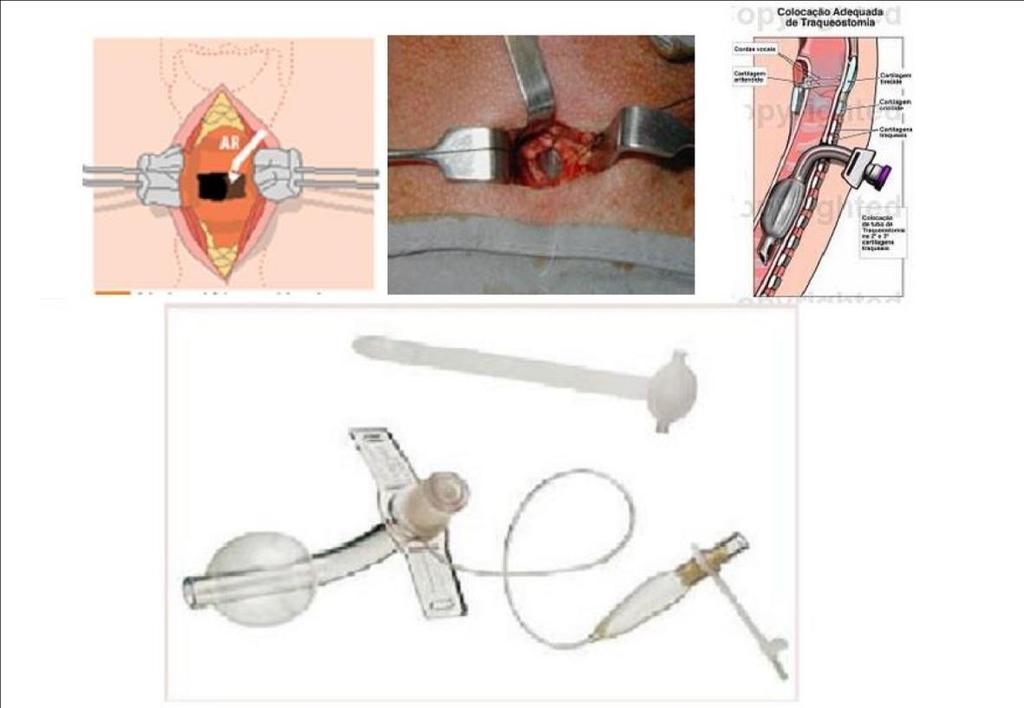 2.2. Cricotireoidostomia: A Cricotireoidostomia, consiste na abertura da membrana cricotireoidea, cricotraqueal ou tireo-hioidea, comunicando-a com o meio externo.