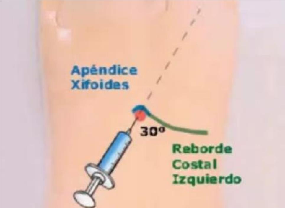 c) Técnica de Marfan: Equipamentos necessários: -Luvas estéreis -Solução tópica antisséptica (Ex. Iodopovidona). -Seringa 50 ml. -Torneira 3 vias. -Cateter agulhado 15 cm, calibre aproximado 16-18G.