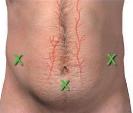 Classificação: -Alívio. -Terapêutica. -Diagnóstica. a) Cuidados: -Avaliar o estado cardiorrespiratório do paciente. b) Técnica: Equipamentos necessários: -Luvas estéreis.