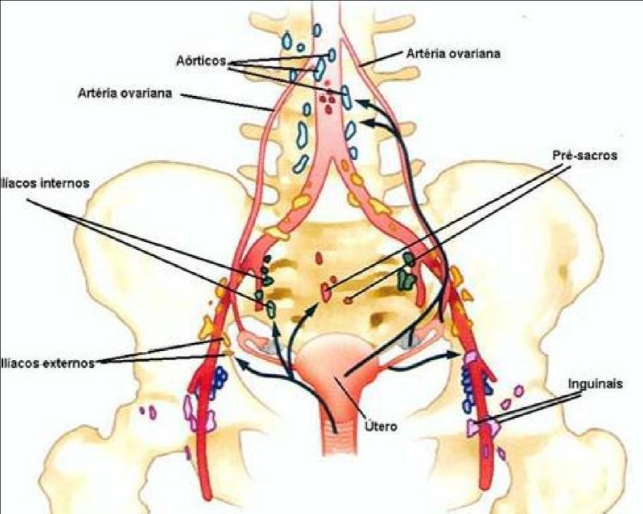 liga a crista ilíaca anterossuperior à cicatriz umbilical e longe dos vasos hipogástricos.