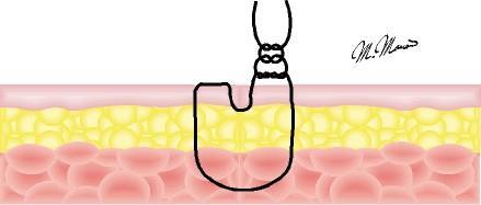 Inicia-se com um ponto simples (longe) e se atravessa a borda oposta próxima à incisão (perto).