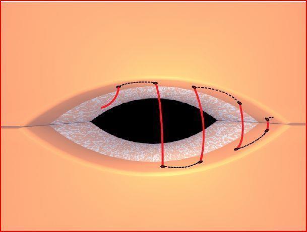 6) Sutura subcuticular contínua (ou intradérmica): A disposição do material de sutura inteiramente dentro da derme subcuticular possibilita uma cicatriz altamente estética, livre de marcas de sutura.