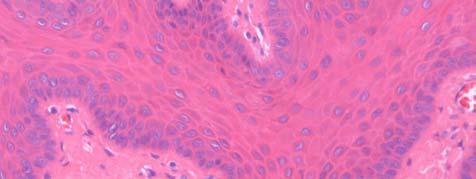 Resultados 116 Tabela 14: Presença de células epiteliais apoptóticas e infiltrado inflamatório nas hiperplasias HFI intrabucal Apoptose Infiltrado Inflamatório Tipo Distribuição Localização HFI lábio