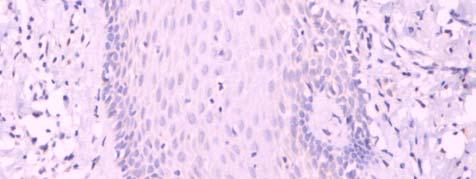 2 Lesão cancerizável A imunomarcação da proteína caspase 3 clivada, no grupo das leucoplasias, mostrou-se positiva em 6