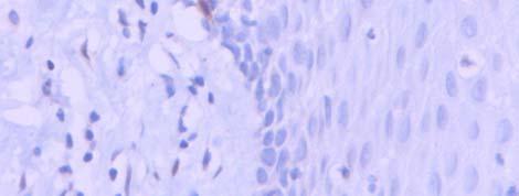 Nas queilites actínicas, dos 9 casos positivos para a c-cas-3 6 apresentavam displasia epitelial (Tabela 18) - Figuras 14