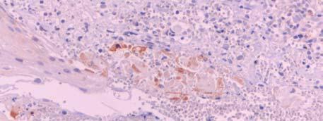 Discussão 163 possivelmente por apresentarem mutações genéticas, mas outras células por se afastarem do centro do tumor sofreram necrose secundariamente ou simultaneamente.