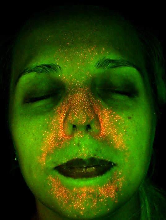 tratamento da Acne LED