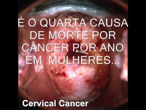 A idade das mulheres entre 25 e 60 anos é considerara importante para o aparecimento da doença. No início, a mulher com câncer de colo uterino não apresenta sintoma algum.