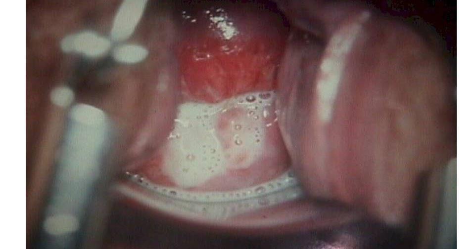 Etiologia: Fungos Cândida albicans (branco