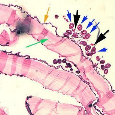 LAM Nº 48 Echinococcus granulosus (cisto hidático ou hidátide) Coloração: Hematoxilina e Eosina Material de preparação: Corte de fígado Características: membrana adventícia (seta verde), fibrosa ao