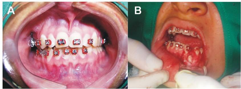 os diagnósticos clínicos e imaginológicos compatíveis com odontoma composto, foi realizada intervenção cirúrgica no bloco cirúrgico da referida instituição, para a remoção do tumor.