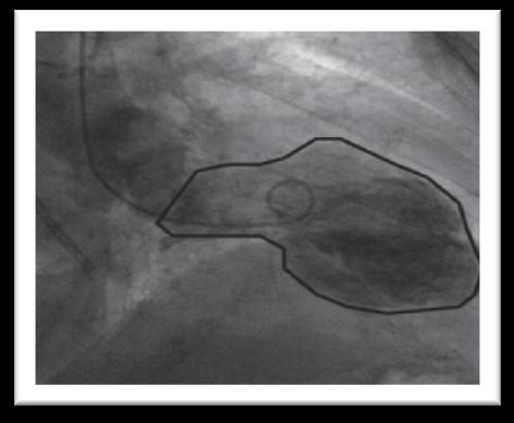 I Introdução A cardiomiopatia de Takotsubo (CMTT), também designada por síndroma de Takotsubo, cardiomiopatia de stress ou por síndroma do coração partido (do inglês Broken Heart Sindrome ), foi