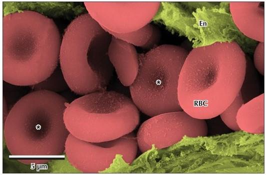 Hemácias Característica: Discos bicôncavos anucleados Flexíveis e maleáveis 99% dos elementos figurados Tempo de vida: 120 dias Hemoglobina Função: Transporte de O 2 e