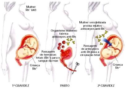 Hemácias Eritroblastose Fetal Doença hemolítica do recém-nascido induzida por