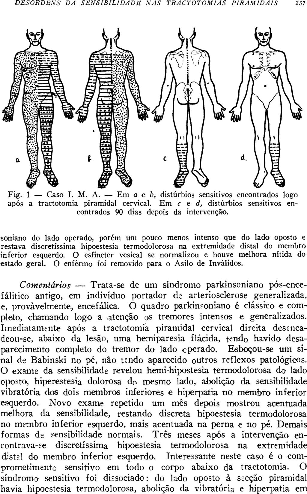 soniano do lado operado, porém um pouco menos intenso que do lado oposto e restava discretíssima hipoestesia termodolorosa na extremidade distai do membro inferior esquerdo.