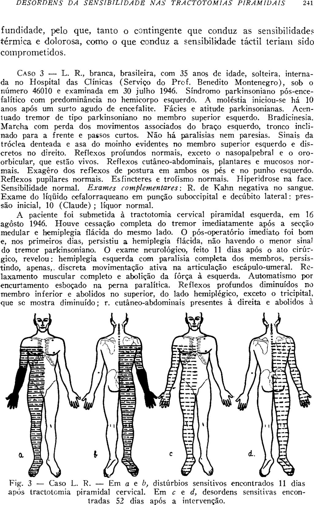 fundidade, pelo que, tanto o contingente que conduz as sensibilidade? térmica e dolorosa, como o que conduz a sensibilidade táctil teriam sido comprometidos. CASO 3 L. R.