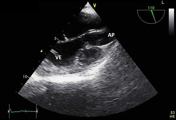 Figura 3 ETE - Corte longitudinal esôfago médio a 110. Origem da artéria pulmonar do ventrículo esquerdo. VE: ventrículo esquerdo; AP: artéria pulmonar.