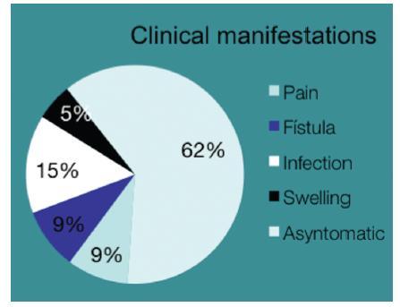 12 Figura 2. Distribuição das manifestações clínicas do Tumor Odontogênico Ceratocístico Fonte: BURGOS et al.