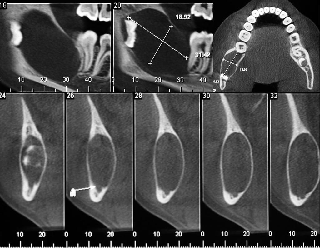 18 Foi solicitada uma tomografia computadorizada de feixe cônico complementar.