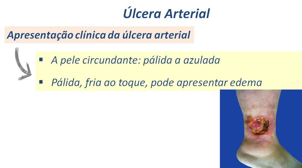 As úlceras arteriais localizam-se geralmente na área do maléolo medial ou lateral (área da polaina) e são tipicamente