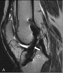 Fig. 1- Homem de 23 anos, com reconstrução do LC há cerca de 1 ano, referindo dor na vertente interna do joelho após traumatismo/entorse.