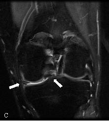 Fragmento meniscal deslocado para a região intercondiliana - sinal do duplo ligamento cruzado posterior (seta) - traduzindo fractura meniscal em asa de cesto. C. Coronal DP com saturação da gordura.