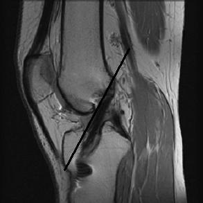 RM permite aferir do posicionamento dos tuneis ósseos femural e tibial [5].