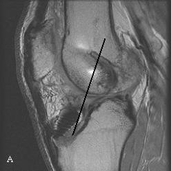 Clinicamente, o doente apresenta dor e/ou diminuição do grau de extensão do joelho. Fig. 4 - Enxerto do LC íntegro num mulher de 38 anos. Sagital DP (TE:20 TR:1960).
