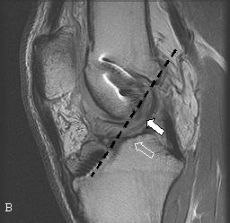 O estudo de RM revelou ainda fractura do menisco externo (aspecto não representado na figura). O exame artroscópico complementar confirmou integridade do enxerto e fractura meniscal.